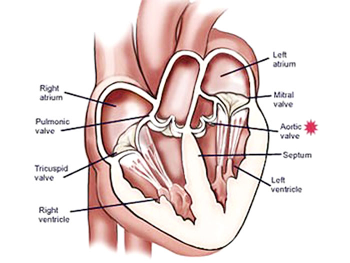 Heart Valve Surgery